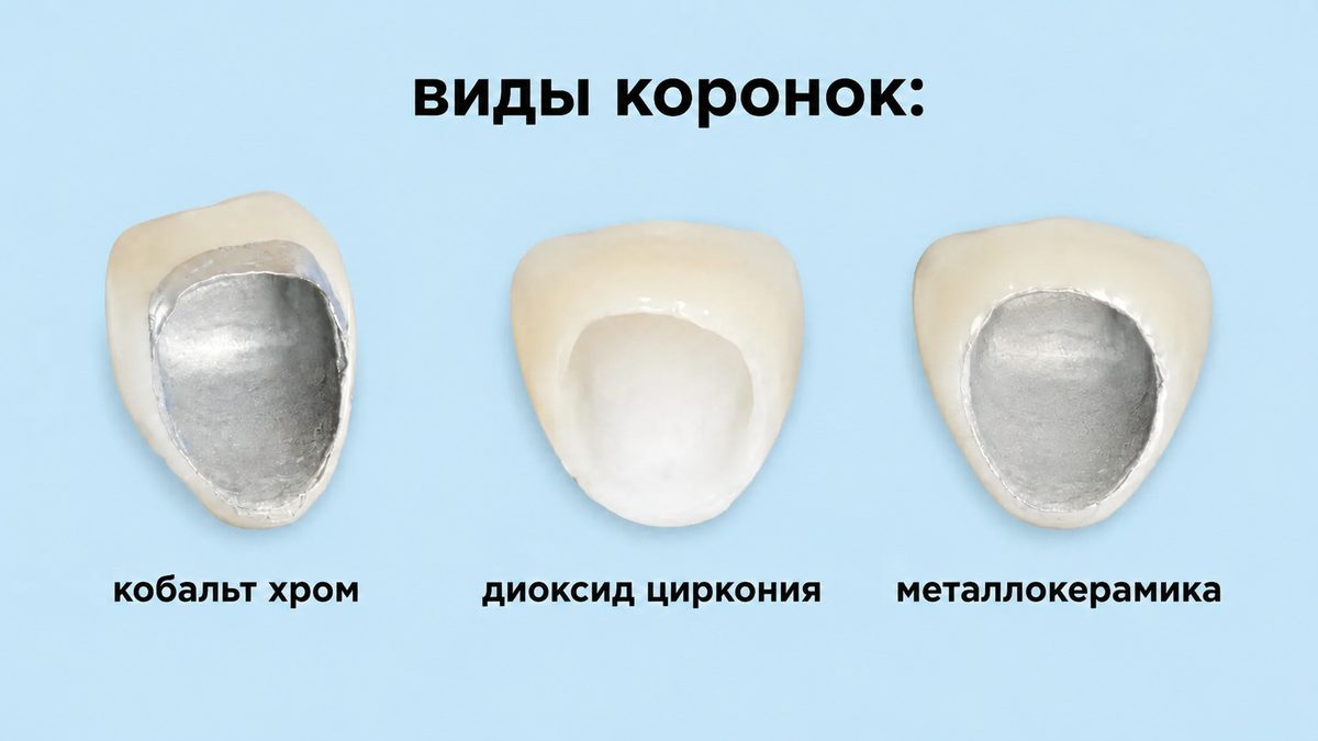 Виды зубных коронок: металлокерамика, кобальт-хром, диоксид циркония
